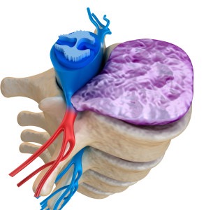 herniated disk