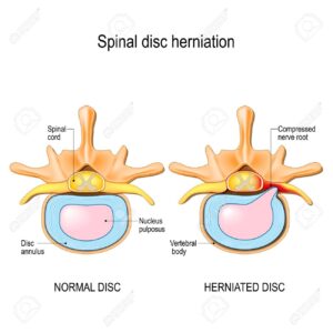spinal-disc-herniation