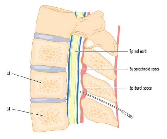 Epidural Steroid Injections Keystone Spine And Pain Management Center Wyomissing Reading